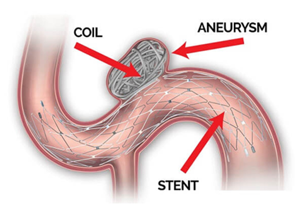 Brain Aneurysm Coiling