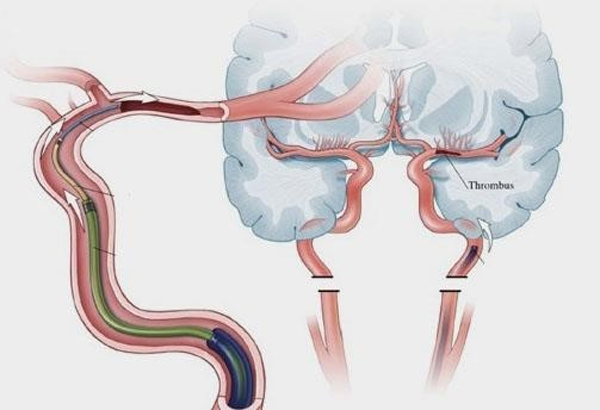 Mechanical Thrombectomy Acute Stroke