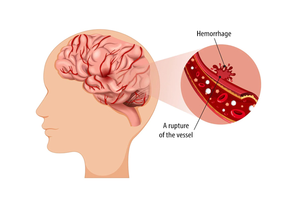 Brain Hemorrhage