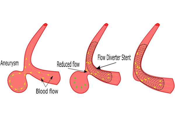 Flow Diverter