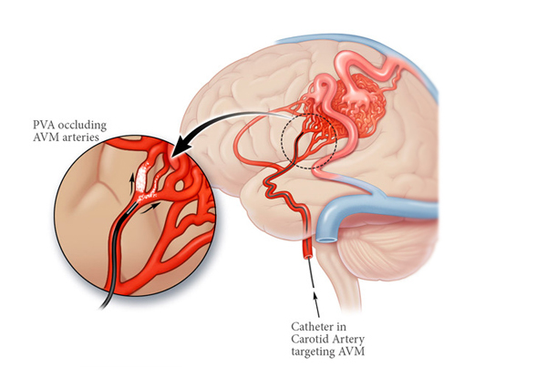 Brain AVM