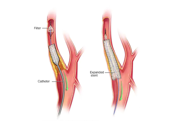 Carotid or Intracranial Stenting