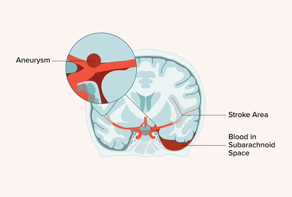 Subarachnoid Hemorrhage